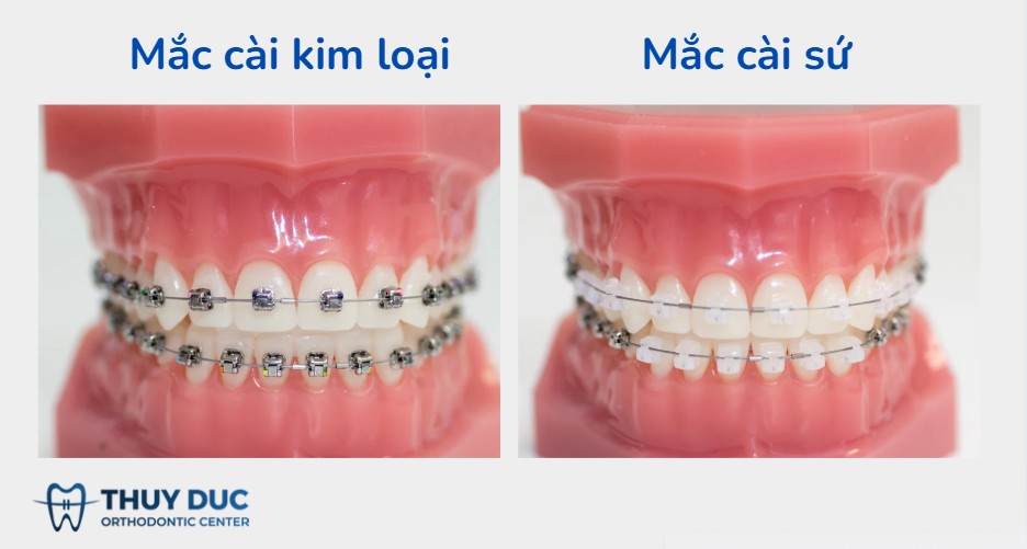 3. Sự khác nhau về phương pháp niềng 1