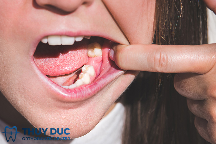 14 tuổi nếu bị mất răng, gãy răng vĩnh viễn thì răng có mọc lại không? 1