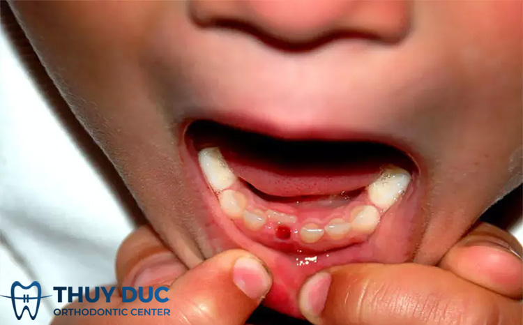 Nhổ răng sữa sớm có ảnh hưởng gì không? 1
