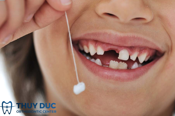 Tìm hiểu về quá trình rụng răng sữa ở trẻ em 1