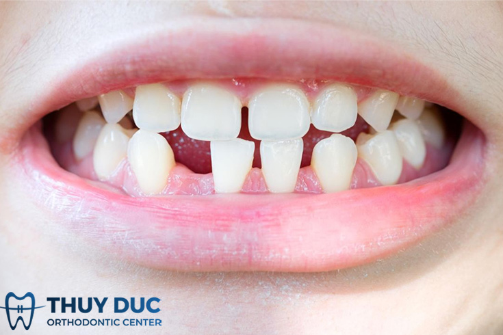 Răng vĩnh viễn không mọc lên có ảnh hưởng gì? 1