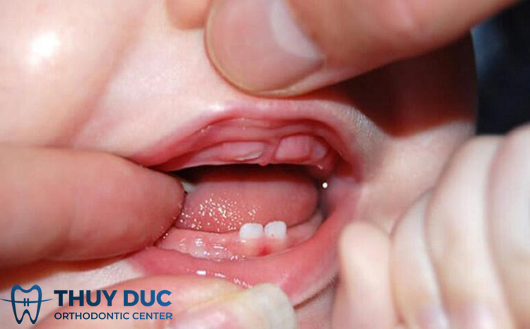 Trẻ thường mọc răng cửa hàm trên trước hay hàm dưới trước? 1