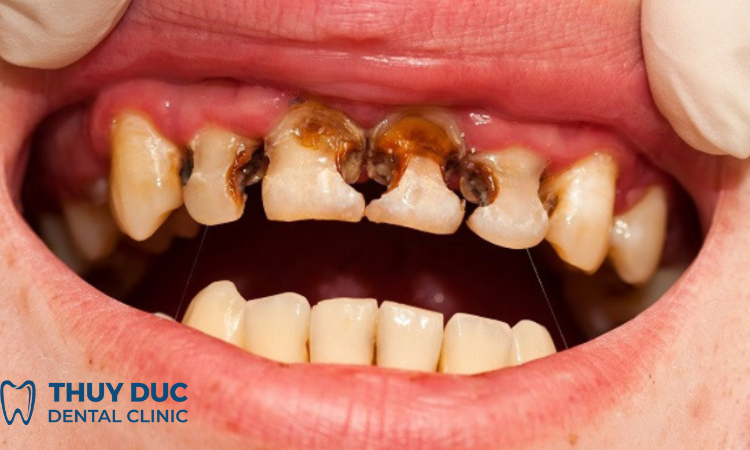 Viêm tủy răng là gì? nguyên nhân và cách khắc phục 1