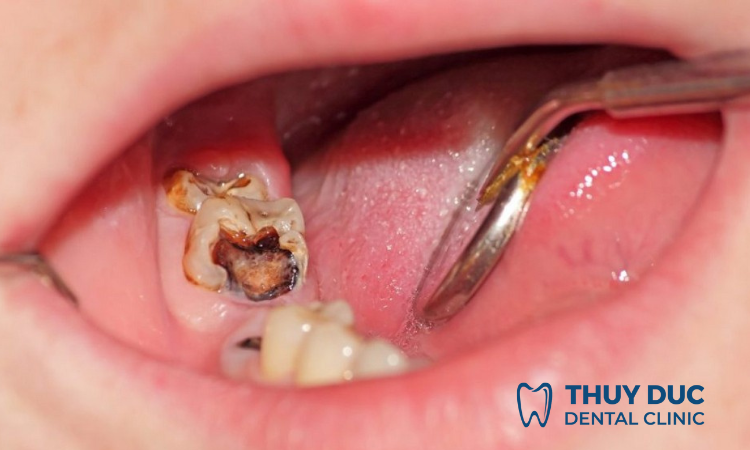 Viêm tuỷ răng là gì? 1