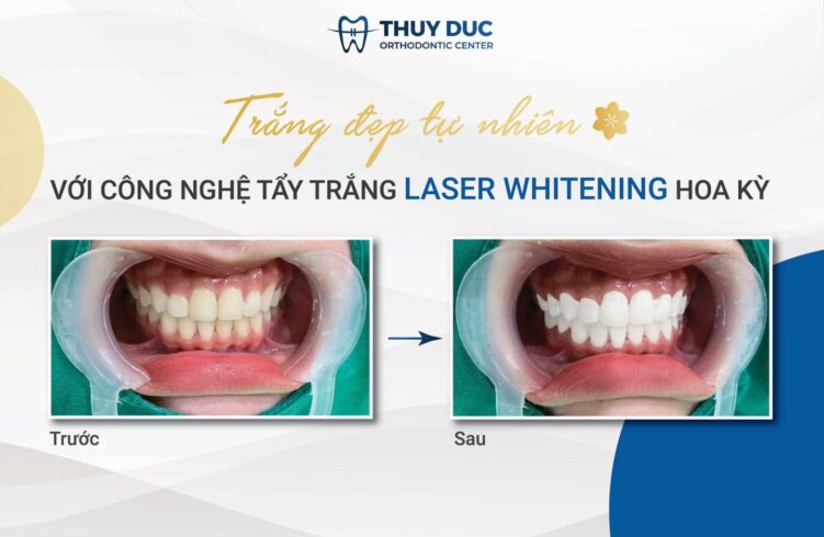 2. Có nên tẩy trắng răng sau khi niềng răng? 1