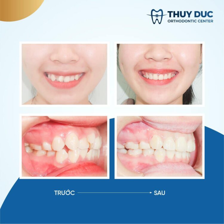 2. Đâu là phương pháp làm răng đều hiệu quả nhất? 1
