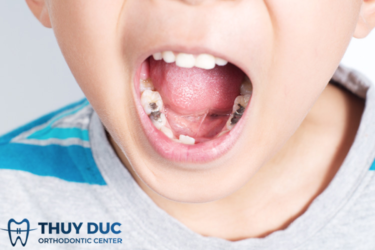 Những ảnh hưởng khi trẻ bị sâu răng sữa? 1