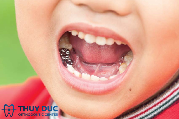 Chụp thép răng sữa cho trẻ – Tìm hiểu AZ điều cần biết