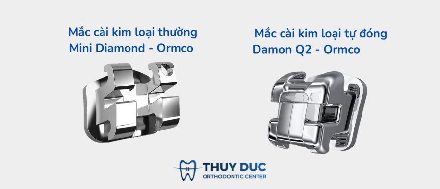 3. Nên niềng răng bằng mắc cài kim loại thường hay tự buộc? 1