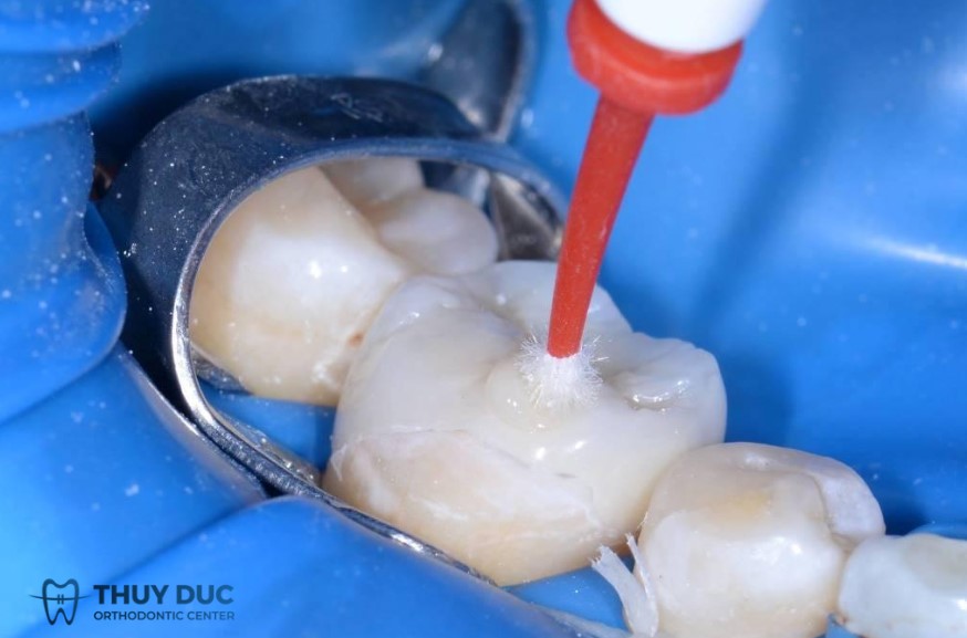 Điều trị sâu răng bằng trám răng 1