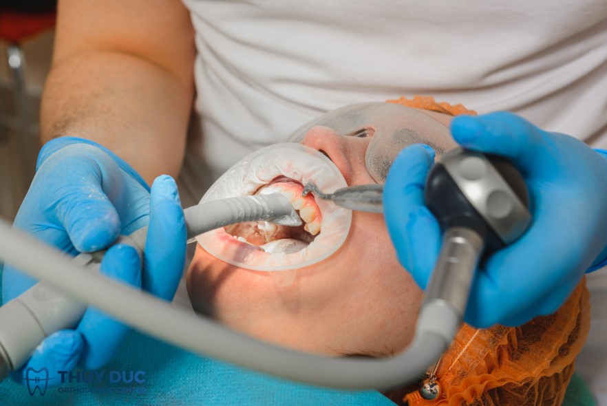 Tầm quan trọng của việc lấy cao răng 1