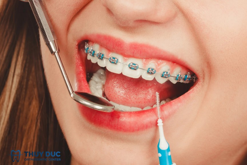 1. Niềng răng mắc cài kim loại thường, mắc cài kim loại tự buộc là gì? 1