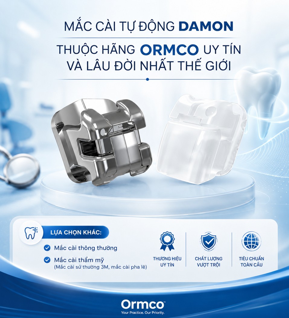 1. Niềng răng mắc cài kim loại thường, mắc cài kim loại tự buộc là gì? 2