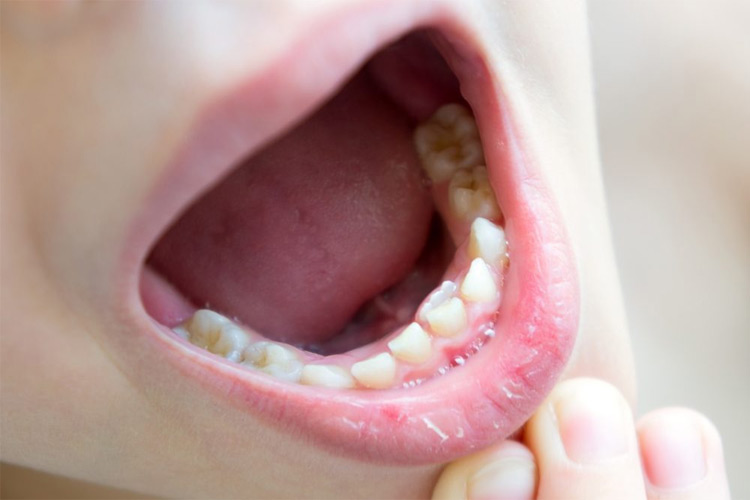 Trẻ có răng mọc lẫy là gì? 1
