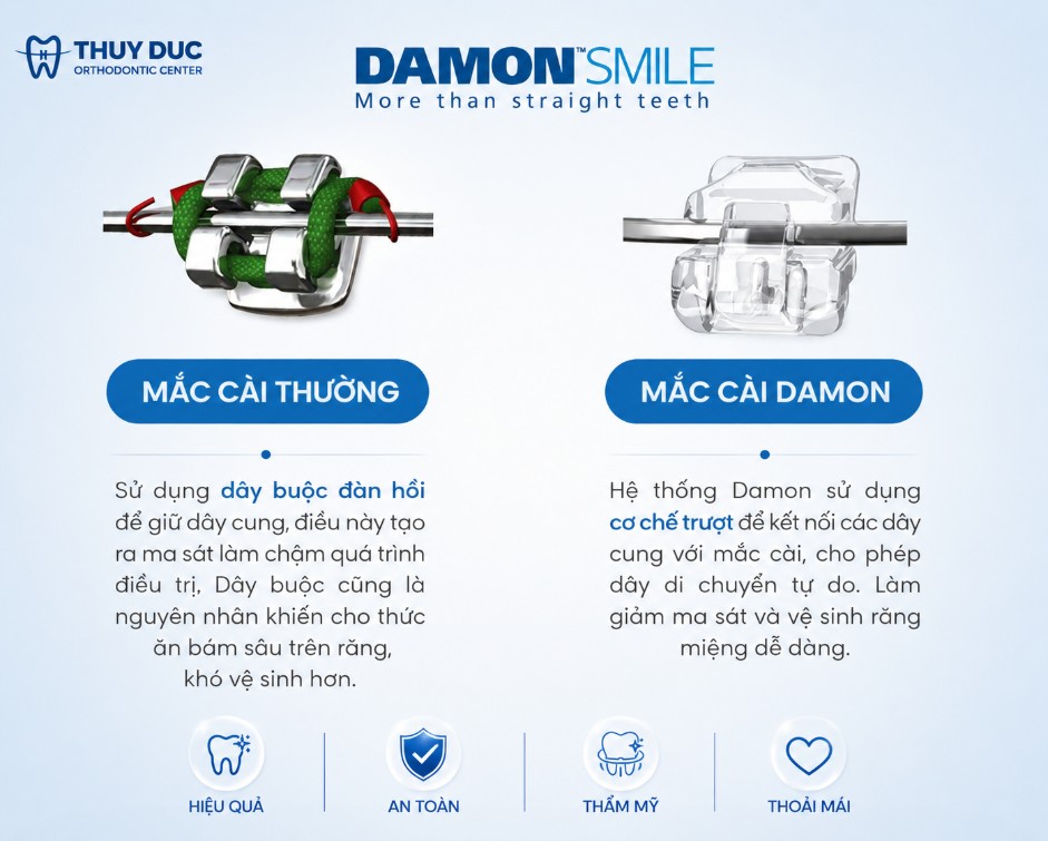 2.3. Trải nghiệm khi đeo niềng 1