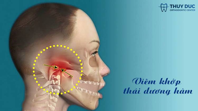 1. Nguyên nhân gây viêm khớp thái dương hàm 1