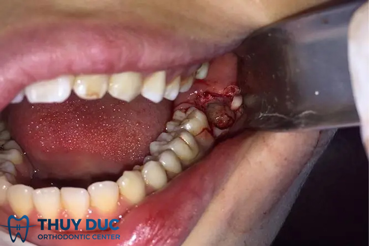 Chảy máu sau nhổ răng là hiện tượng bình thường 1