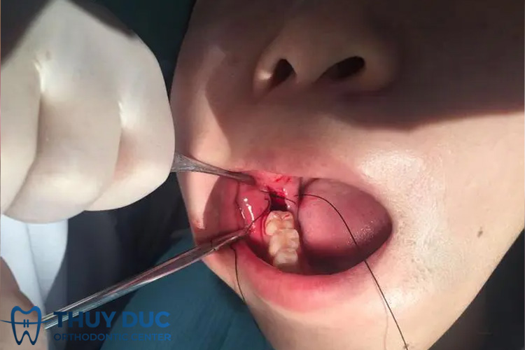 Các trường hợp có nguy cơ chảy máu nhổ răng nhiều hơn bình thường 1