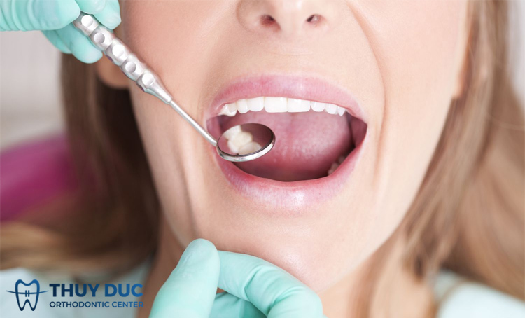 Răng bị sâu lỗ to có nghiêm trọng không? Điều trị thế nào? 1