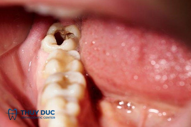 Bệnh nào thường xảy ra trong khoang miệng? 1