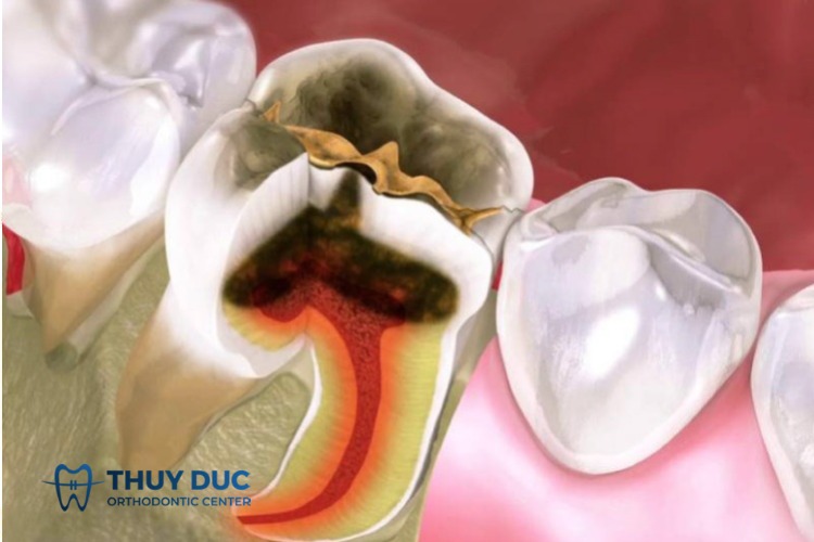 Tìm hiểu cơ chế và tác dụng của thuốc diệt tủy răng 1