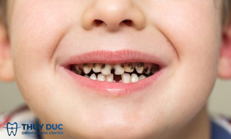 Cách chữa sâu răng cho trẻ 4 tuổi hiệu quả cao 1