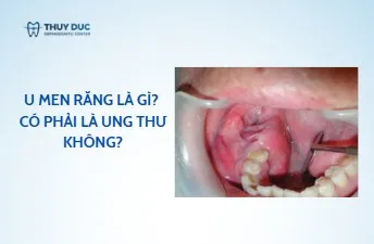U men răng là gì? Có phải là ung thư không?