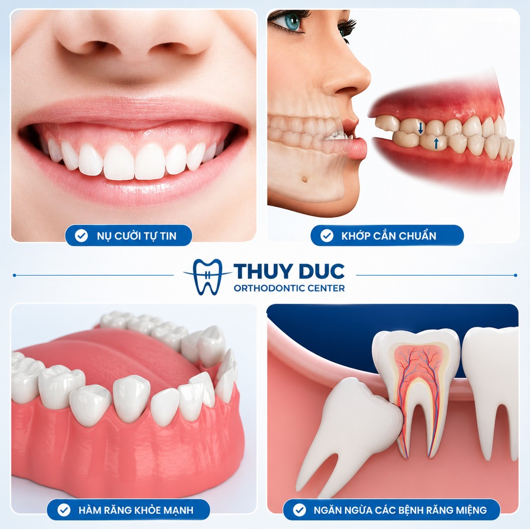 3. Các trường hợp cần nhổ răng khi niềng răng Invisalign 1 3. Các trường hợp cần nhổ răng khi niềng răng Invisalign 1