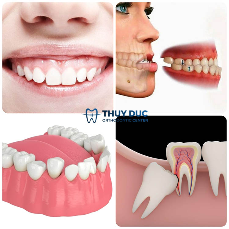 3. Các trường hợp cần nhổ răng khi niềng răng Invisalign 1