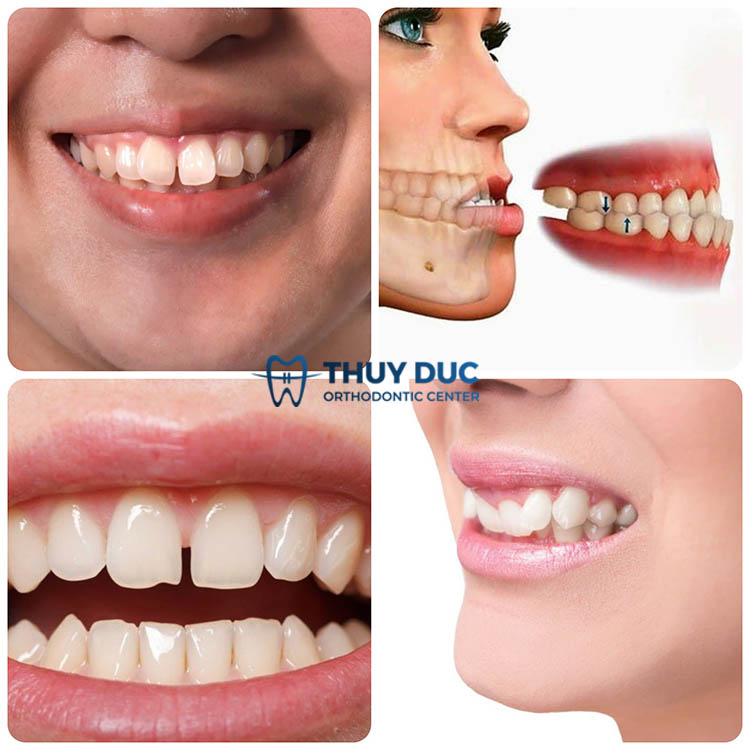 3. Niềng răng Invisalign phù hợp với những đối tượng nào? 1