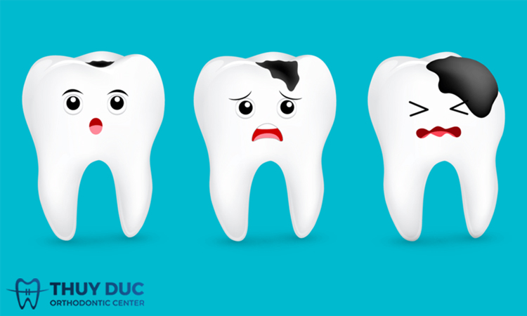 Có con sâu răng hay không? – Tất cả những điều cần biết về bệnh sâu răng