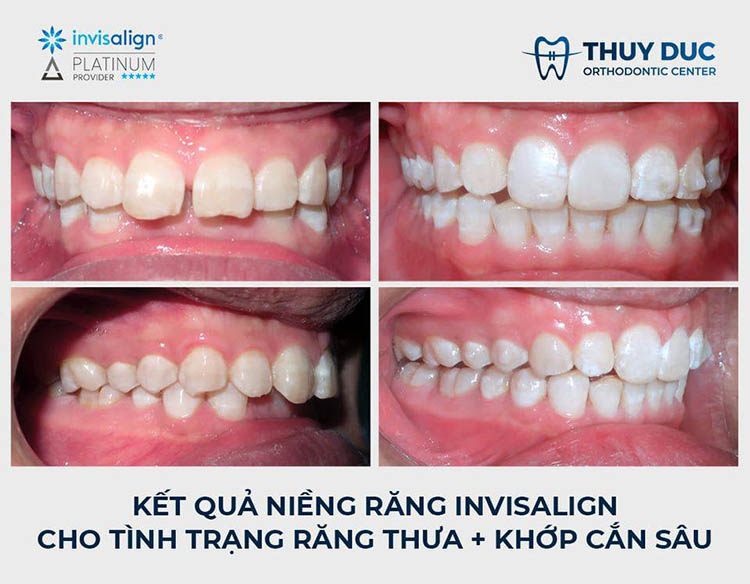 4. Hình ảnh khách hàng niềng răng Invisalign tại nha khoa Thúy Đức 1