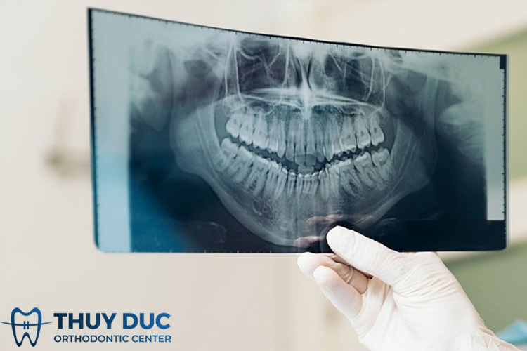 Tại sao chụp  X-quang răng là cần thiết trong nha khoa? 2