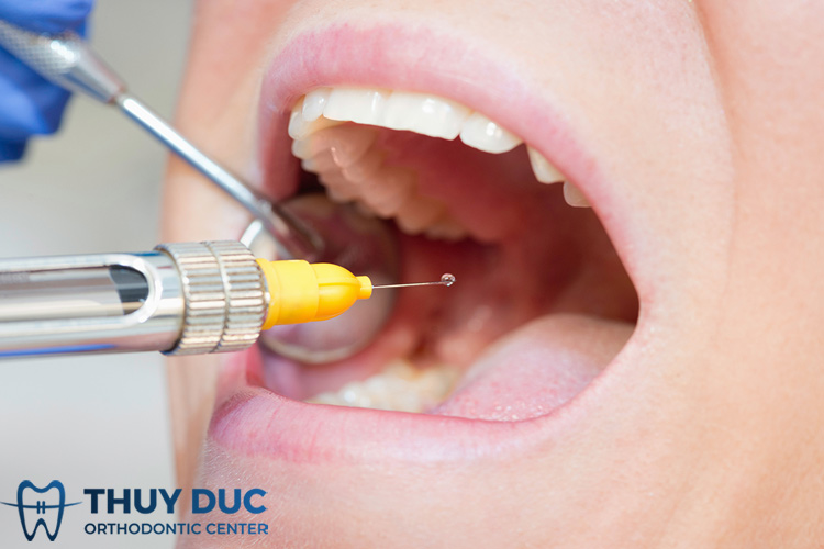 Thuốc tê nhổ răng có tác dụng trong bao lâu?