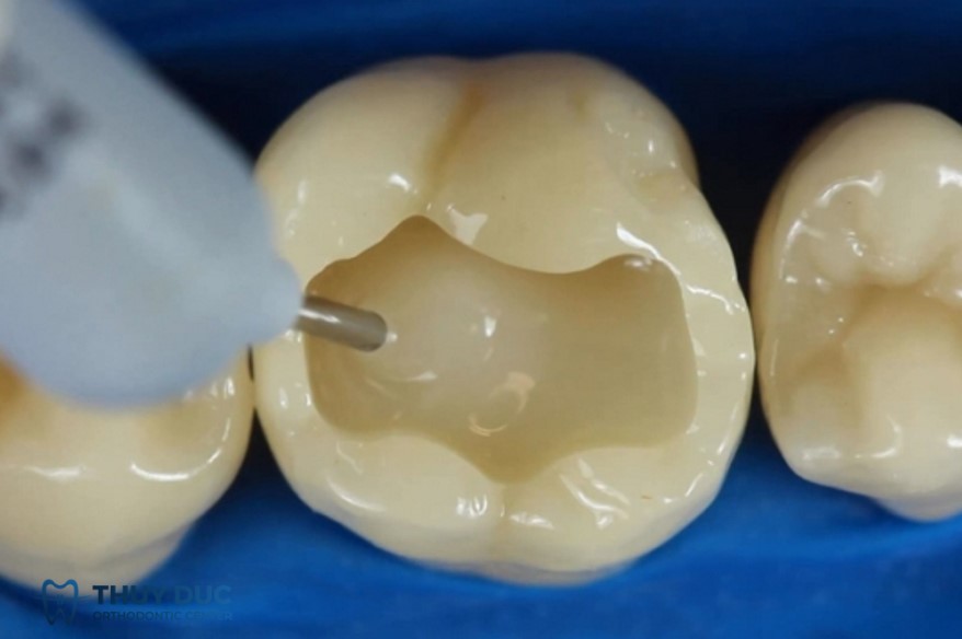 Đặc điểm của trám răng composite 1