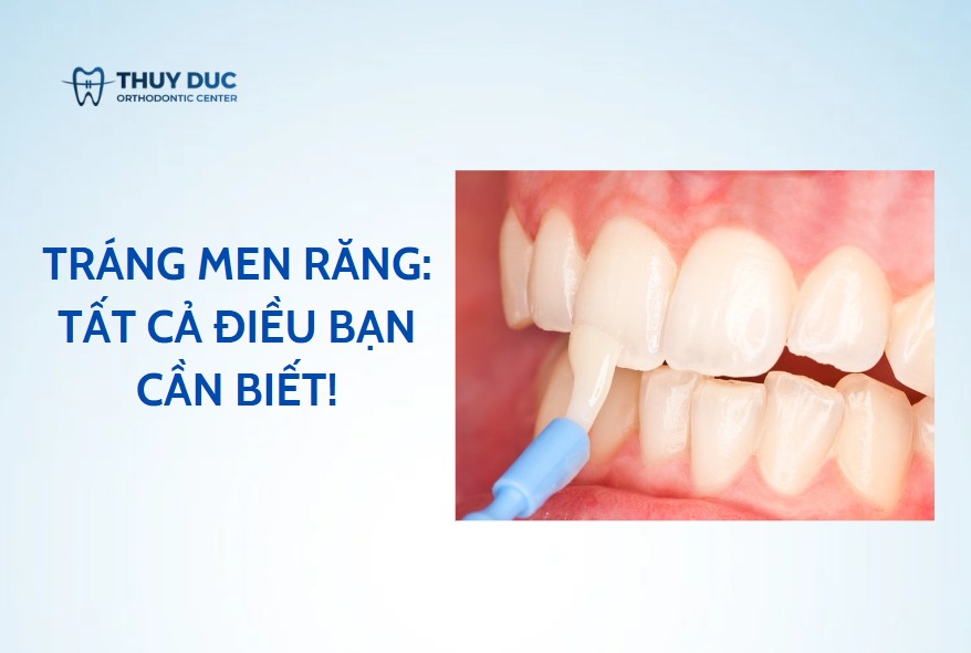 Tráng men răng: Tất cả điều bạn cần biết! - Nha Khoa Thúy Đức