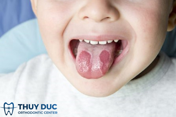 Bệnh cam miệng ở trẻ là gì? 1