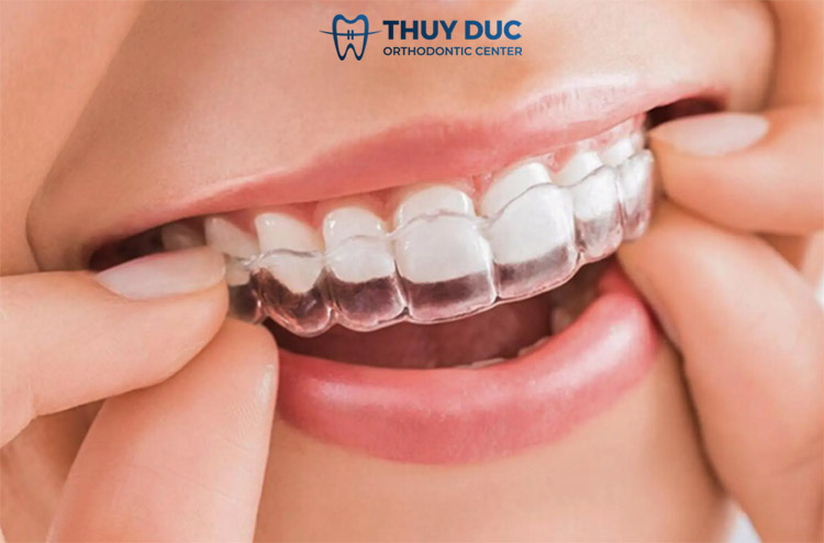 Giai đoạn nào gắn Attachment khi niềng răng Invisalign? 1
