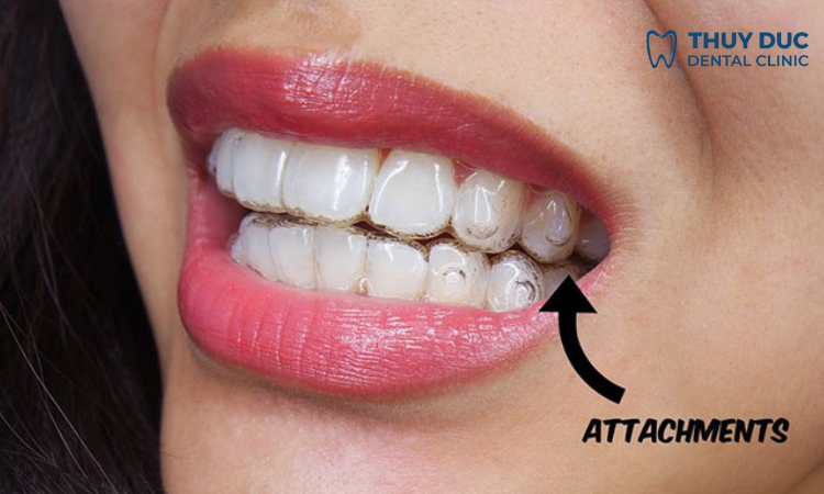 Gắn Attachment có ảnh hưởng đến thẩm mỹ răng miệng không? 1