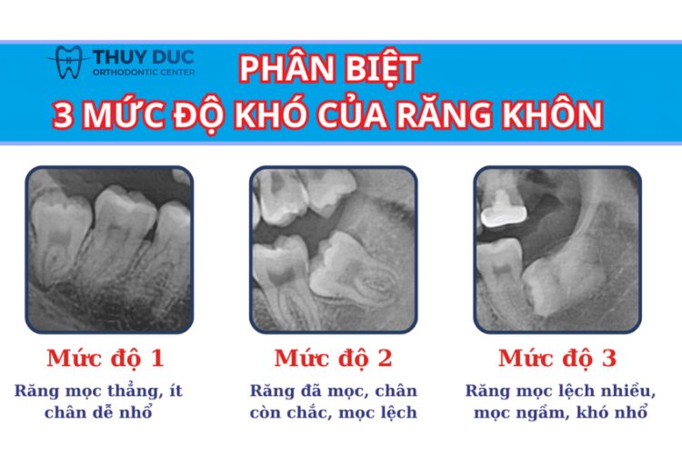 Các trường hợp răng khôn cần được nhổ bỏ 1