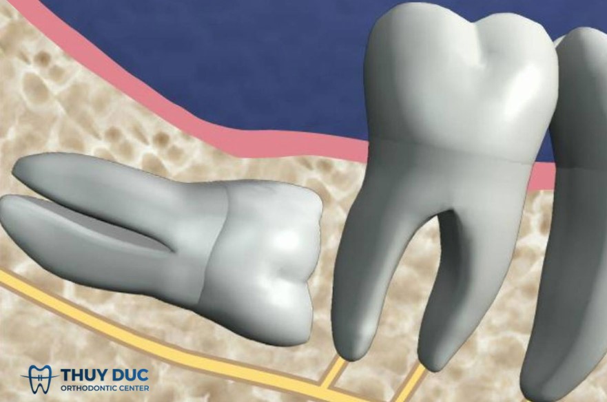 Sâu răng số 7 bên cạnh 1