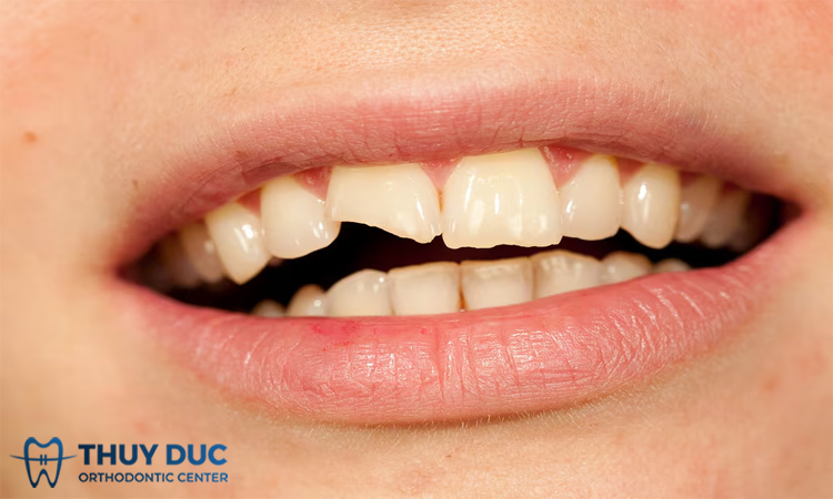 Giải đáp bí ẩn về điềm báo mẻ răng – bị mẻ răng có điềm gì?
