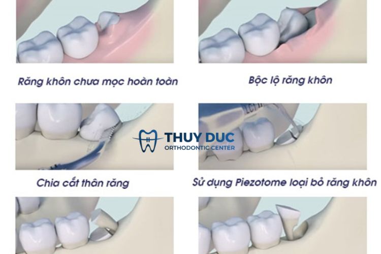 Quy trình nhổ răng khôn bằng máy siêu âm Piezotome 2