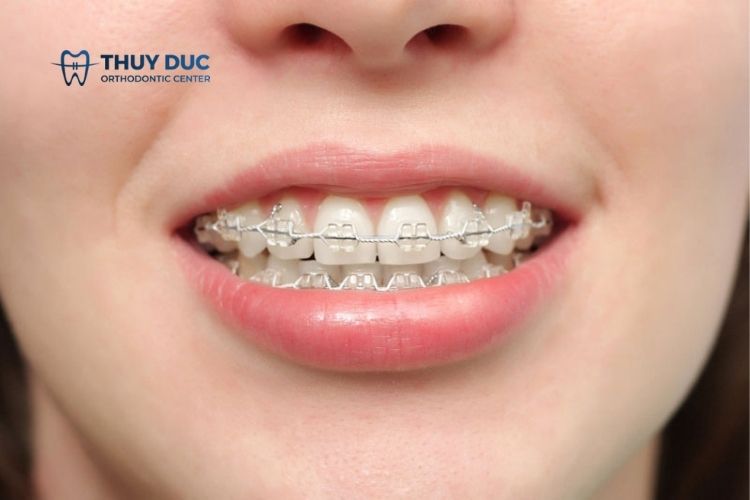 Niềng răng có phải nhổ răng không? 1