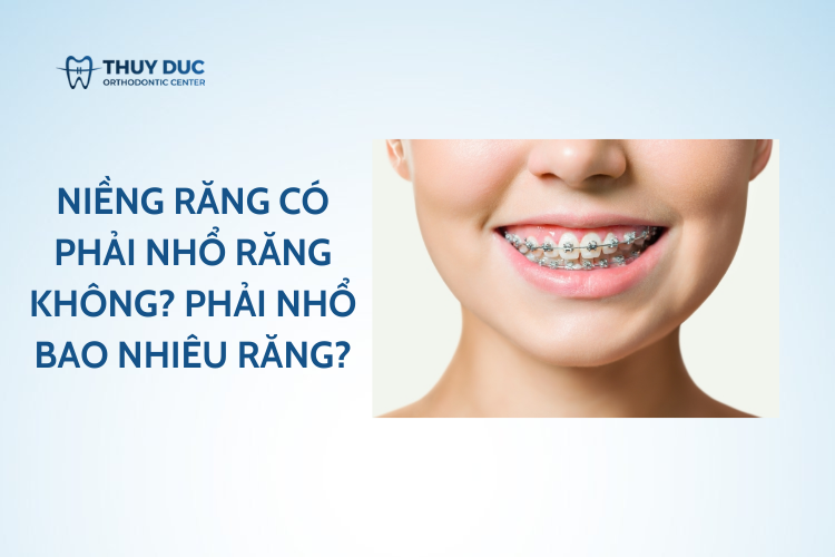 Niềng răng có phải nhổ răng không? Phải nhổ bao nhiêu răng?