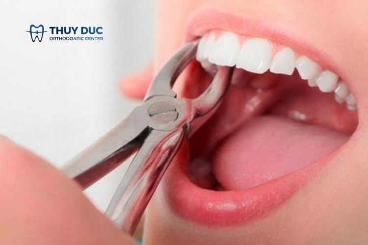 Niềng răng phải nhổ bao nhiêu răng? 1