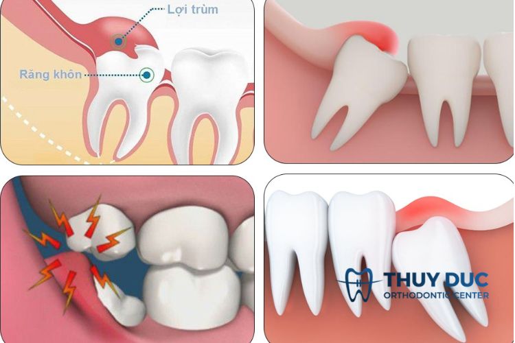 Giải đáp lợi trùm răng khôn là gì? 1