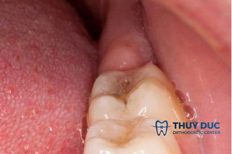 Những dấu hiệu khi răng khôn bị lợi trùm 1