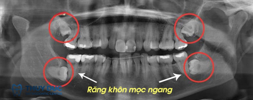 Tại sao bắt buộc phải chụp X – quang răng khôn? 1