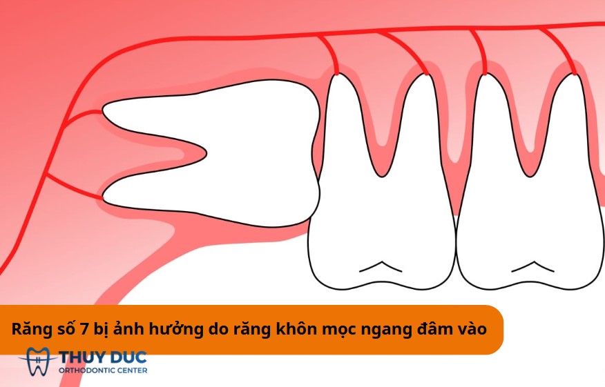 Xương và hàm răng bị hủy hoại 1